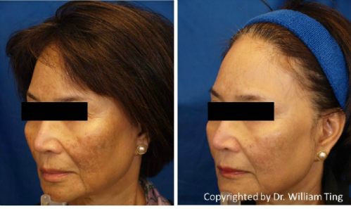 Melasma and Pigmentation Treatment San Ramon | California Dermatology