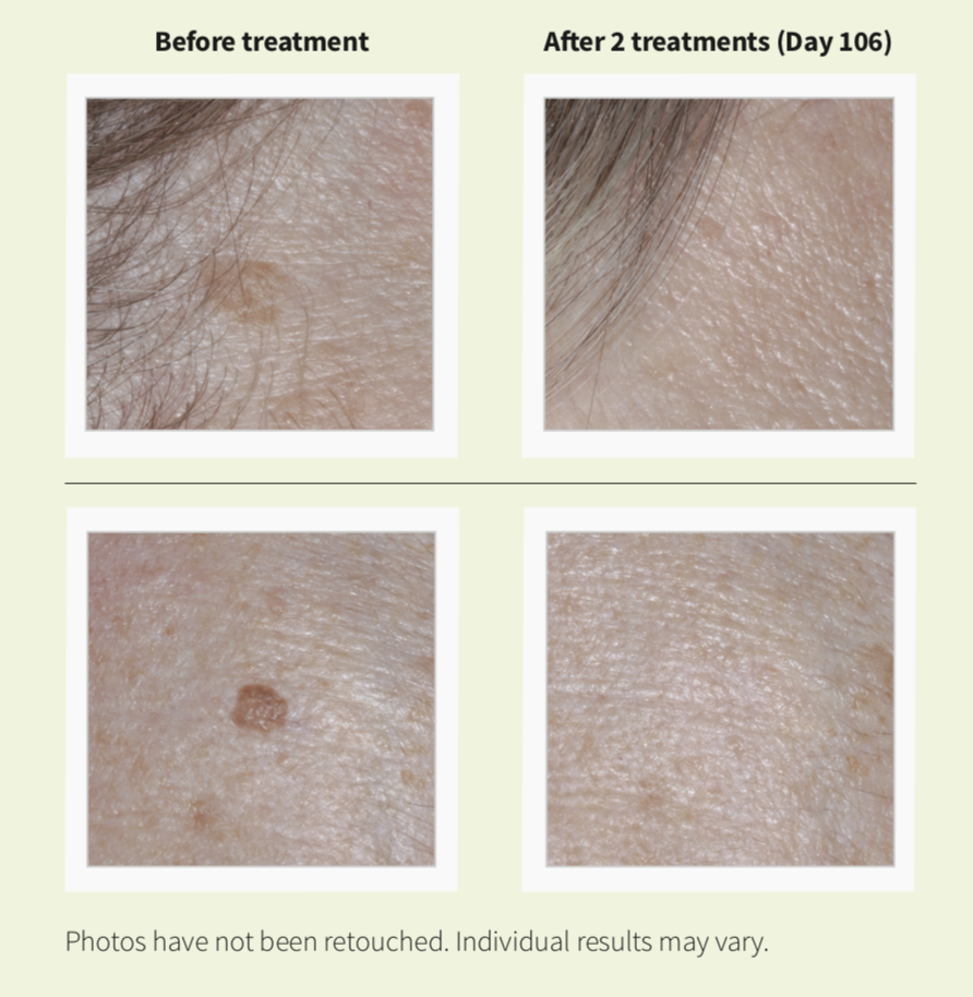 Eskata For Treatment Of Seborrheic Keratoses San Ramon Ca